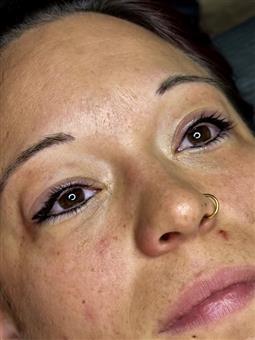 Combined Upper and Lower Lash Enhancement