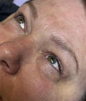 Upper Lash Enhancement